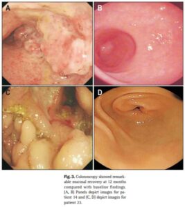 Autoimmune colon before and after (2 people)