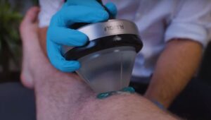 How PiezoWave Shockwave Therapy Works
