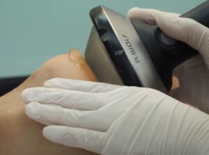 Frequently Asked Questions - PiezoWave shockwave therapy