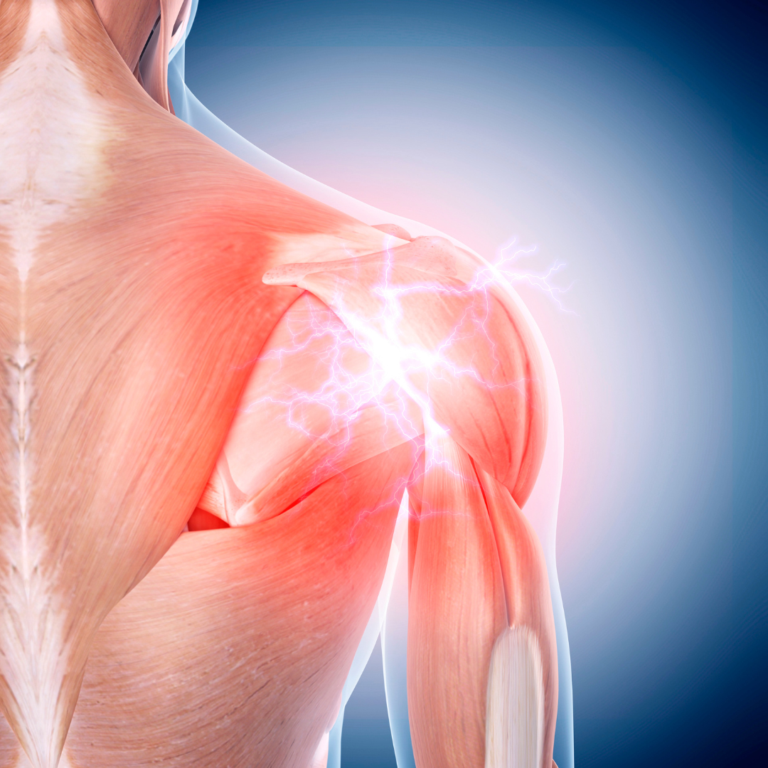 Shoulder pain canva square 768x768